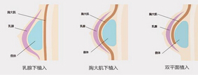 北京假体隆胸的价格