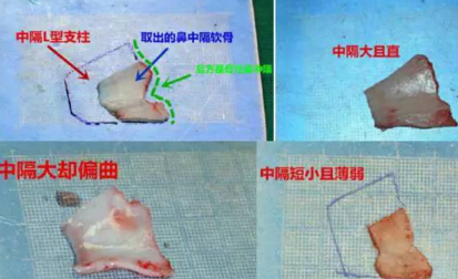 鼻整形用鼻中隔软骨*吗？