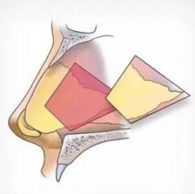 鼻整形用鼻中隔软骨*吗？