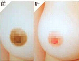 乳晕太大要怎么变小