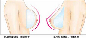 假体隆胸后还能正常哺乳吗？