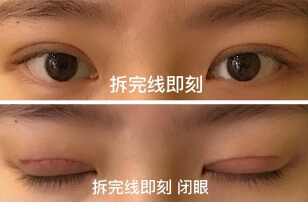 上海九院眼科李茅医生做的全切+去皮去脂