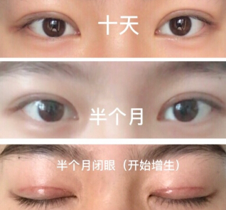 上海九院眼科李茅医生做的全切+去皮去脂