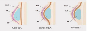 假体隆胸材料有没有什么副作用