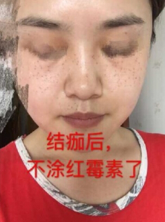 做了激光祛斑术后*果反馈和经验分享