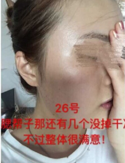 做了激光祛斑术后*果反馈和经验分享