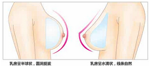 北京假体隆胸需要好多钱