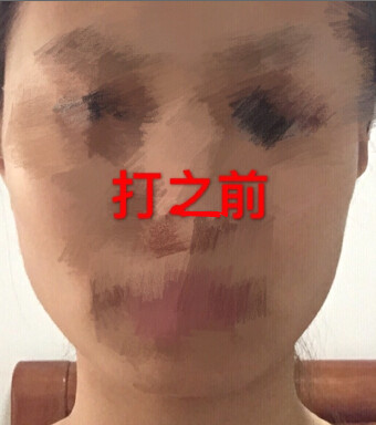 注射*术后*果反馈