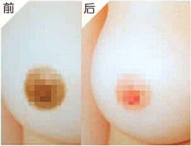 乳晕大不好看怎么办