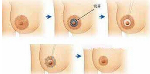 乳晕大是怎么回事？色彩加深怎么办