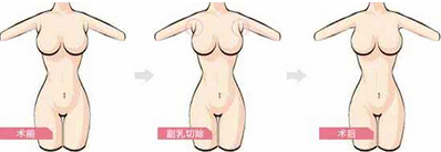 副乳切除手术需要注意什么