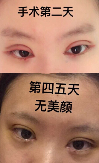 大连爱德丽格宋立男医生做的双眼皮开眼角