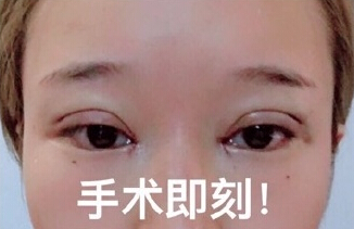 成都美莱整形美容医院做的微切双眼皮