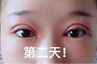 成都美莱整形美容医院做的微切双眼皮