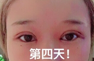 成都美莱整形美容医院做的微切双眼皮