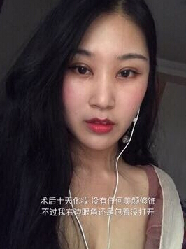 北京美莱整形美容医院金鸿医生做的双眼皮开眼