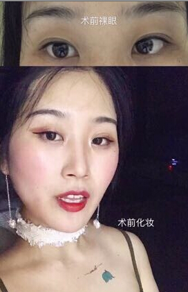 北京美莱整形美容医院金鸿医生做的双眼皮开眼