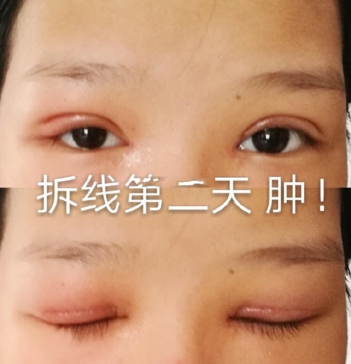 成都景华医学美容医院江涛做的双眼皮