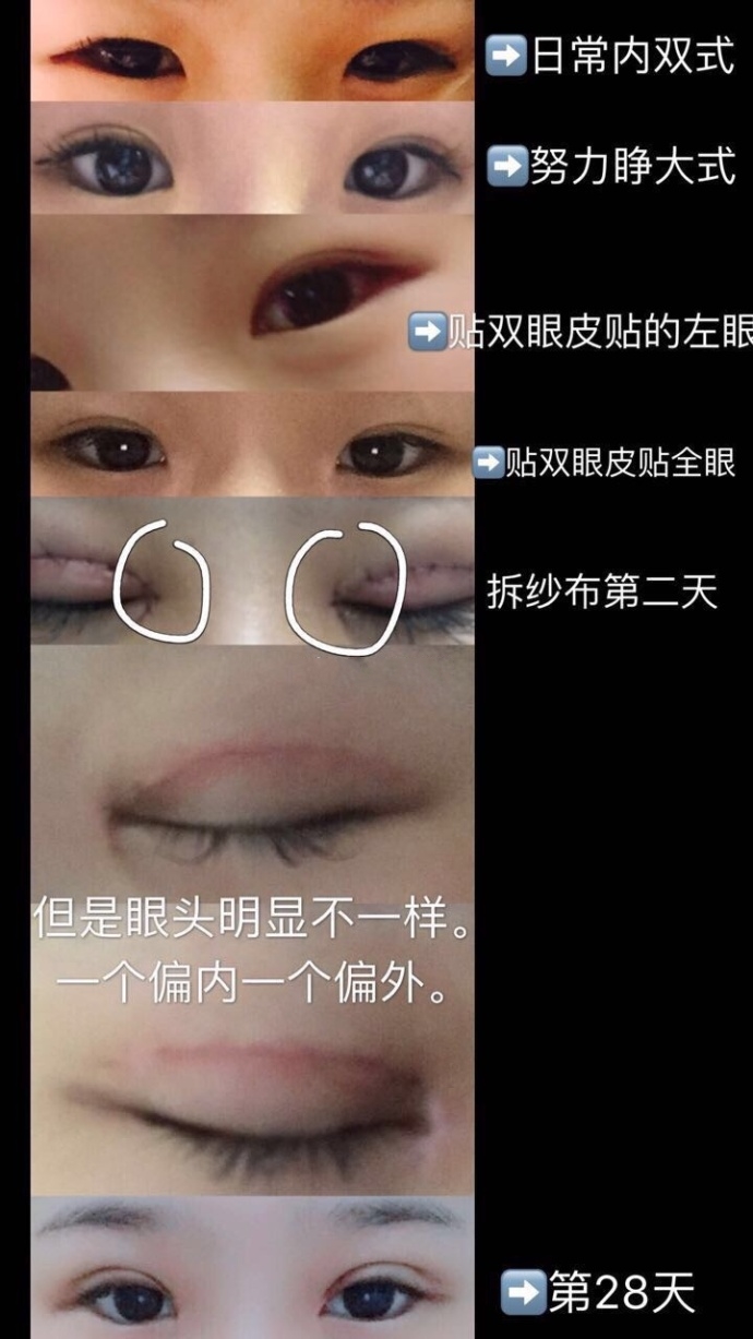 江苏美贝尔整形医院做的全切双眼皮