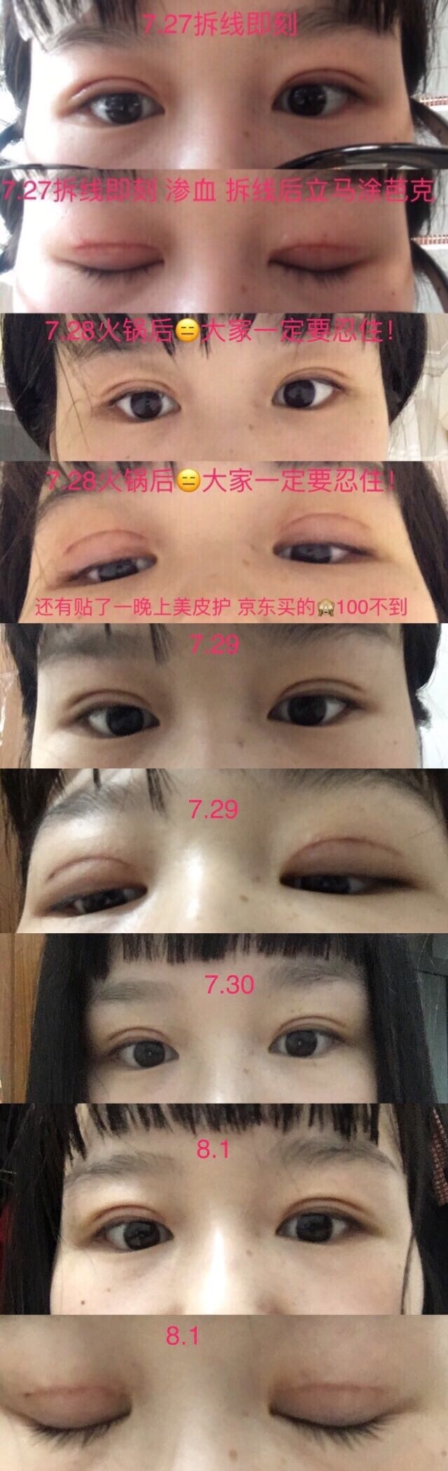 常州第一人民医院眼科潘恂医生做的双眼皮