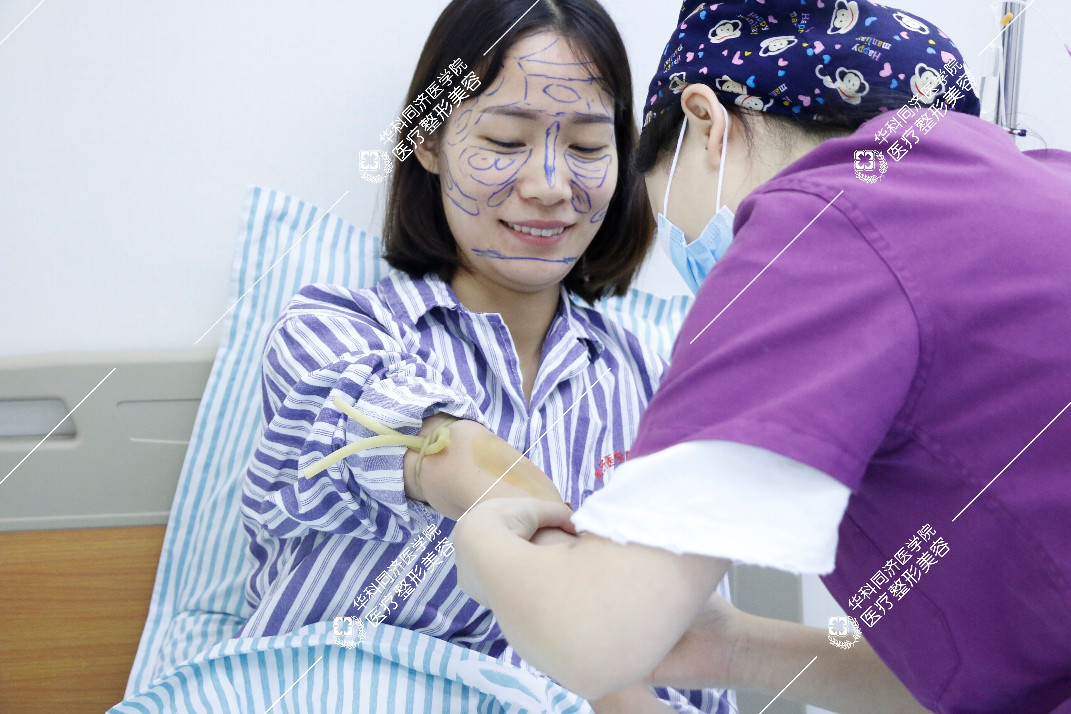 武汉同济医院做的自体脂肪面部填充