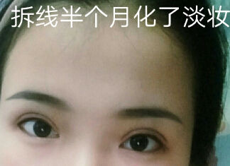 四川美莱整形美容医院做的双眼皮