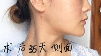 长沙伊美唐中华做的面部吸脂和脂肪填充下巴