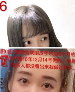 上海九院黄如林医生处做的全切去皮+开眼角