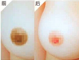 乳晕整形手术有几种