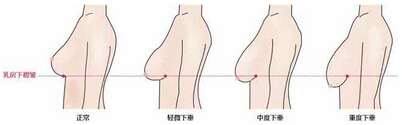 乳房松弛矫正的方法有什么