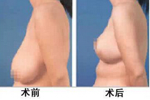 乳房松弛矫正的方法有什么