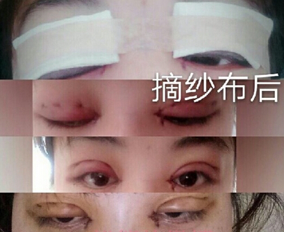 邯郸都市整形医院李医生的韩式三点+开眼角