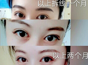 邯郸都市整形医院李医生的韩式三点+开眼角