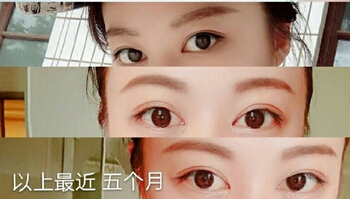 邯郸都市整形医院李医生的韩式三点+开眼角