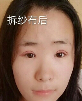 省中王金明医生做的双眼皮加内眼角