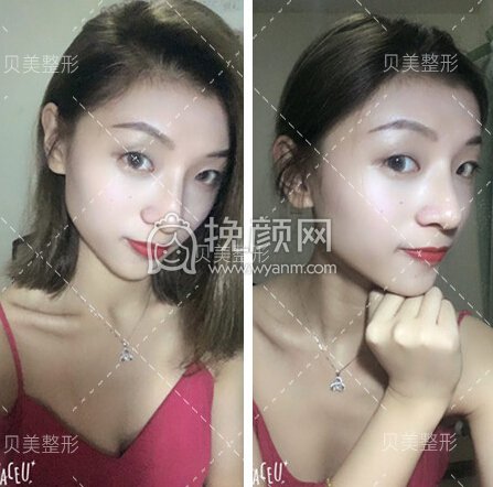 长沙贝美宽鼻缩窄+驼峰鼻矫正+隆鼻垫鼻尖