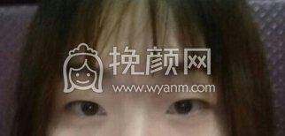 上海伊莱美李旭东做的双眼皮+开眼角+提肌