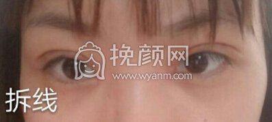 上海伊莱美李旭东做的双眼皮+开眼角+提肌