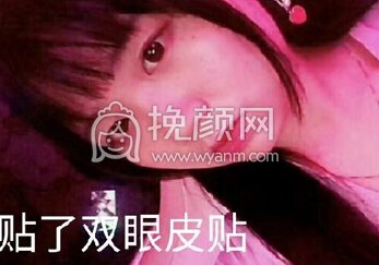 长沙美莱周文亮做的全切+提肌+去除囊肿