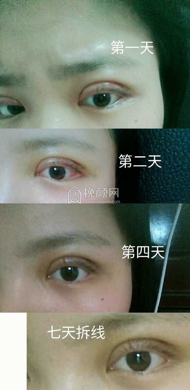 长沙美莱周文亮做的全切+提肌+去除囊肿