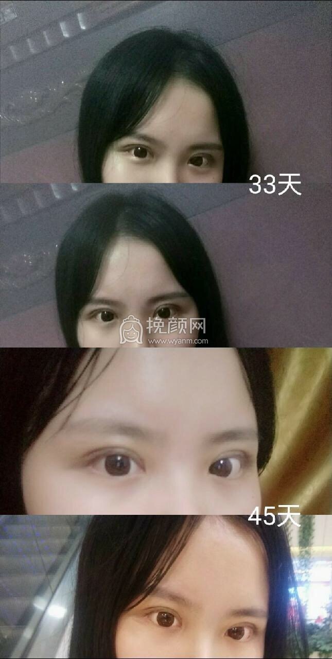 长沙美莱周文亮做的全切+提肌+去除囊肿