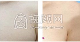 北京副乳切除手术的价钱是多少