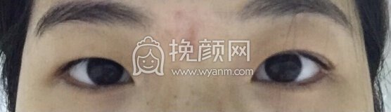 上海九院丁伟医生做的双眼皮+内眼角