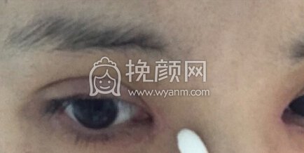 成都大华医院双眼皮+开内眼角