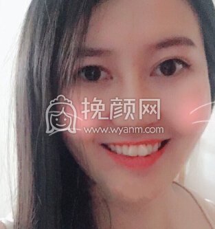 苏州高新区曼陀罗美容医院李主任玻尿酸隆鼻