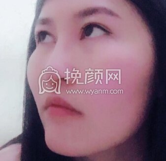 苏州高新区曼陀罗美容医院李主任玻尿酸隆鼻