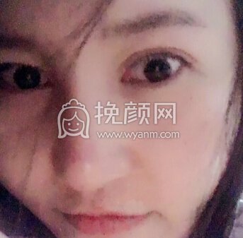 苏州高新区曼陀罗美容医院李主任玻尿酸隆鼻