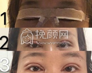 合肥华美朱院长做的*双眼皮+开眼角