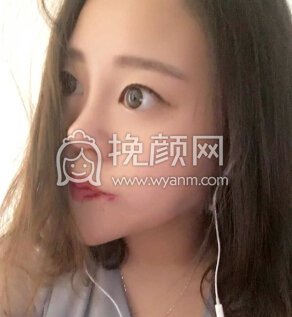 武汉卓美医院王海平教授给做的*