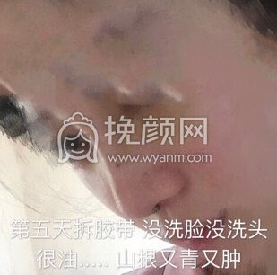 上海喜美徐文龙医生做的*